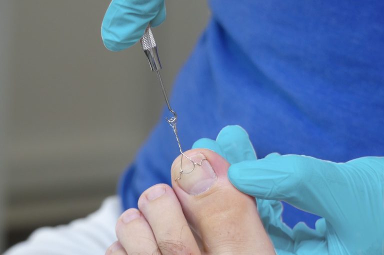 Nahaufnahme eines Fußes an dem eine Spangenbehandlung durchführt wird.