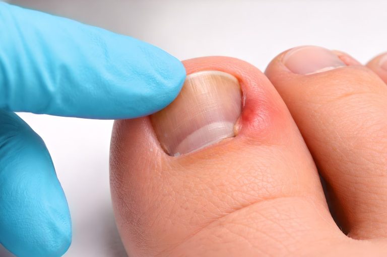 Nahaufnahme eines entzündeten Nagels am Zeh.